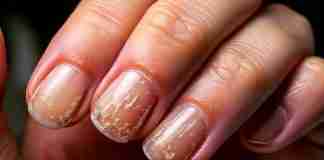 ¿Uñas frágiles? Descubre por qué se escaman y cómo salvarlas antes de que sea tarde